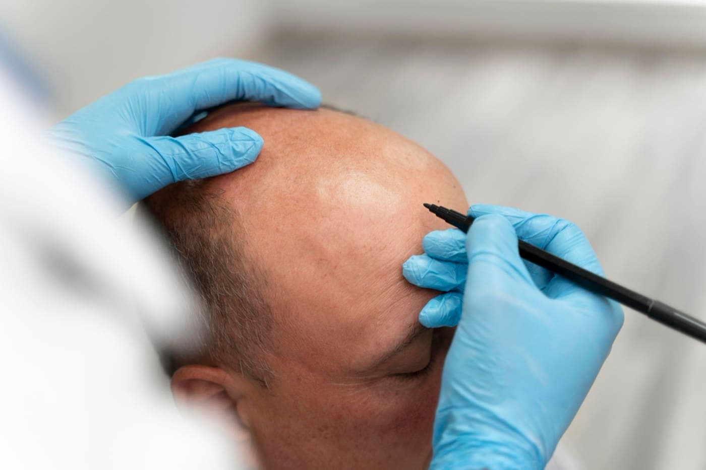 زراعة الشعر واللحية والحواجب في اسطنبول